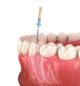 shrewsbury root canal