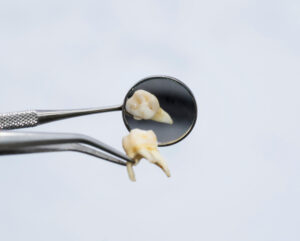 shrewsbury tooth extraction