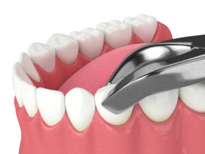 shrewsbury tooth extraction