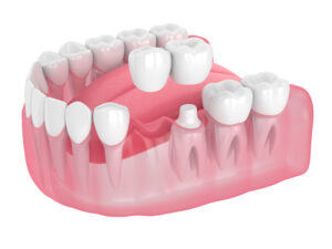 shrewsbury dental bridge