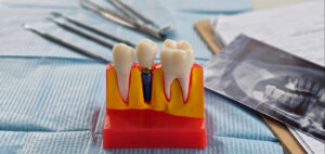 shrewsbury dental implants